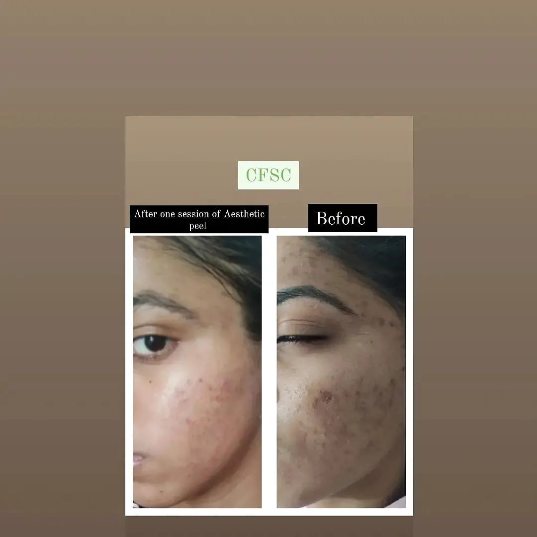 Before After Facial Treatment